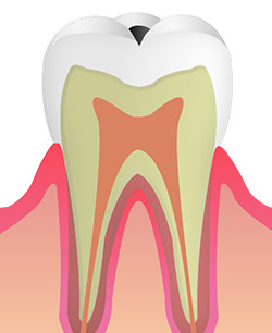 エナメル質のむし歯:C1
