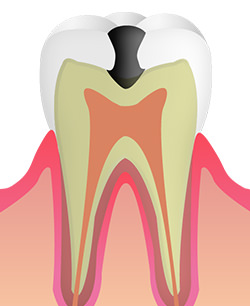 象牙質のむし歯:C2